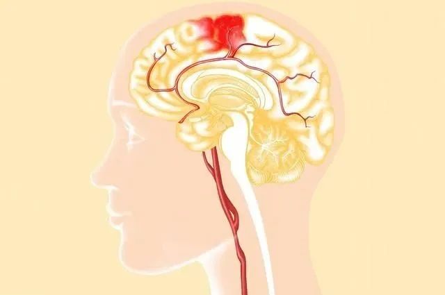 精准穿刺、免开颅清除脑内血肿 —— 一根直径不到4mm的穿刺针成功救治脑出血